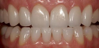 Smile Before & After Gallery - Patient 43748204 - Image 2