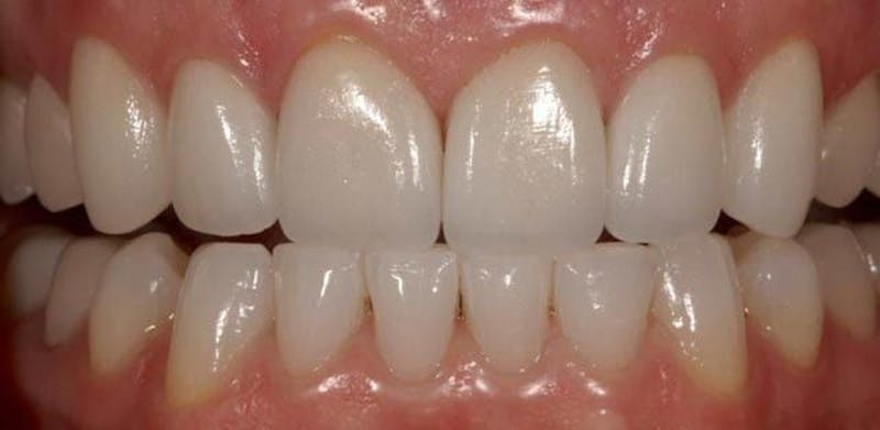 Smile Before & After Gallery - Patient 43748204 - Image 2