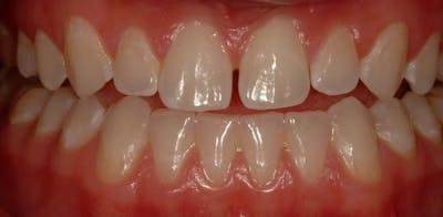 Smile Before & After Gallery - Patient 43748206 - Image 1
