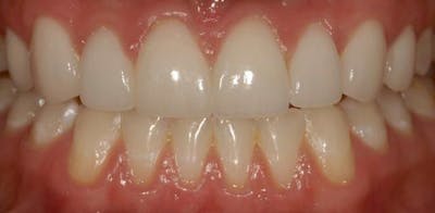 Smile Before & After Gallery - Patient 43748206 - Image 2