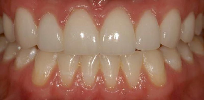 Smile Before & After Gallery - Patient 43748206 - Image 2