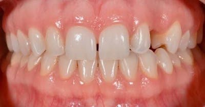 Smile Before & After Gallery - Patient 43748208 - Image 1