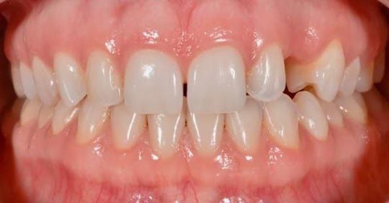 Smile Before & After Gallery - Patient 43748208 - Image 1