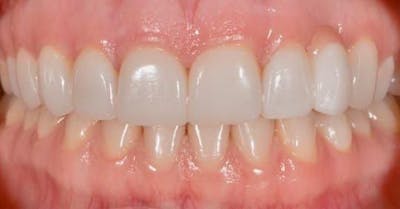 Smile Before & After Gallery - Patient 43748208 - Image 2