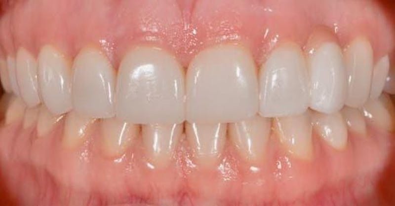 Smile Before & After Gallery - Patient 43748208 - Image 2