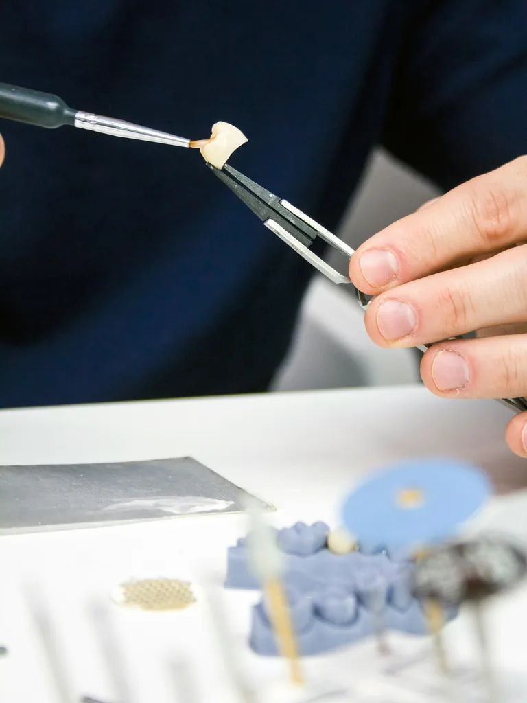 Tandtechnicus brengt een laag aan op een tandkroon met pincet, illustrerend voor kronen vergoeding en kronen verzekering.