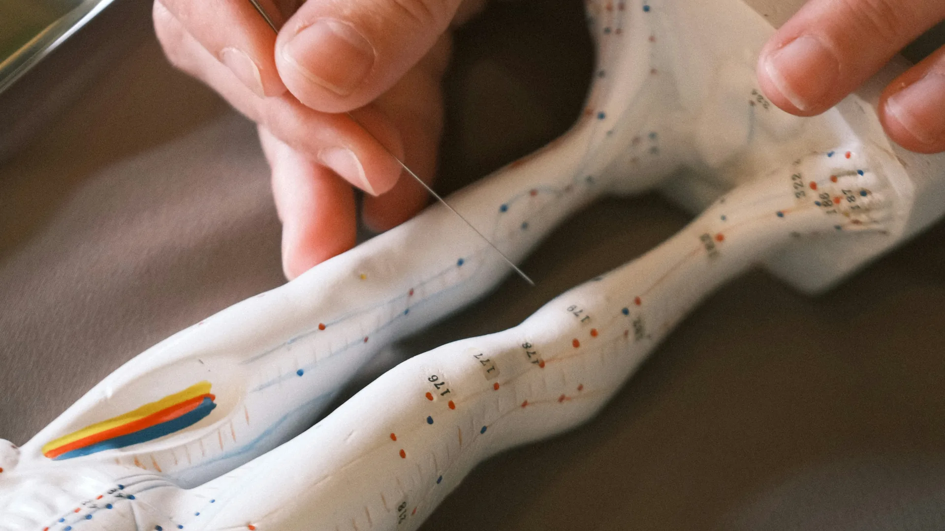 Hand plaatst fijne accupunctuurnaald, passend bij accupunctuur vergoeding en aanvullende verzekering