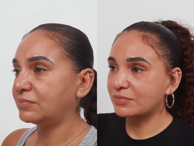 Deep Plane Facelift Before & After Gallery - Patient 55610379 - Image 1