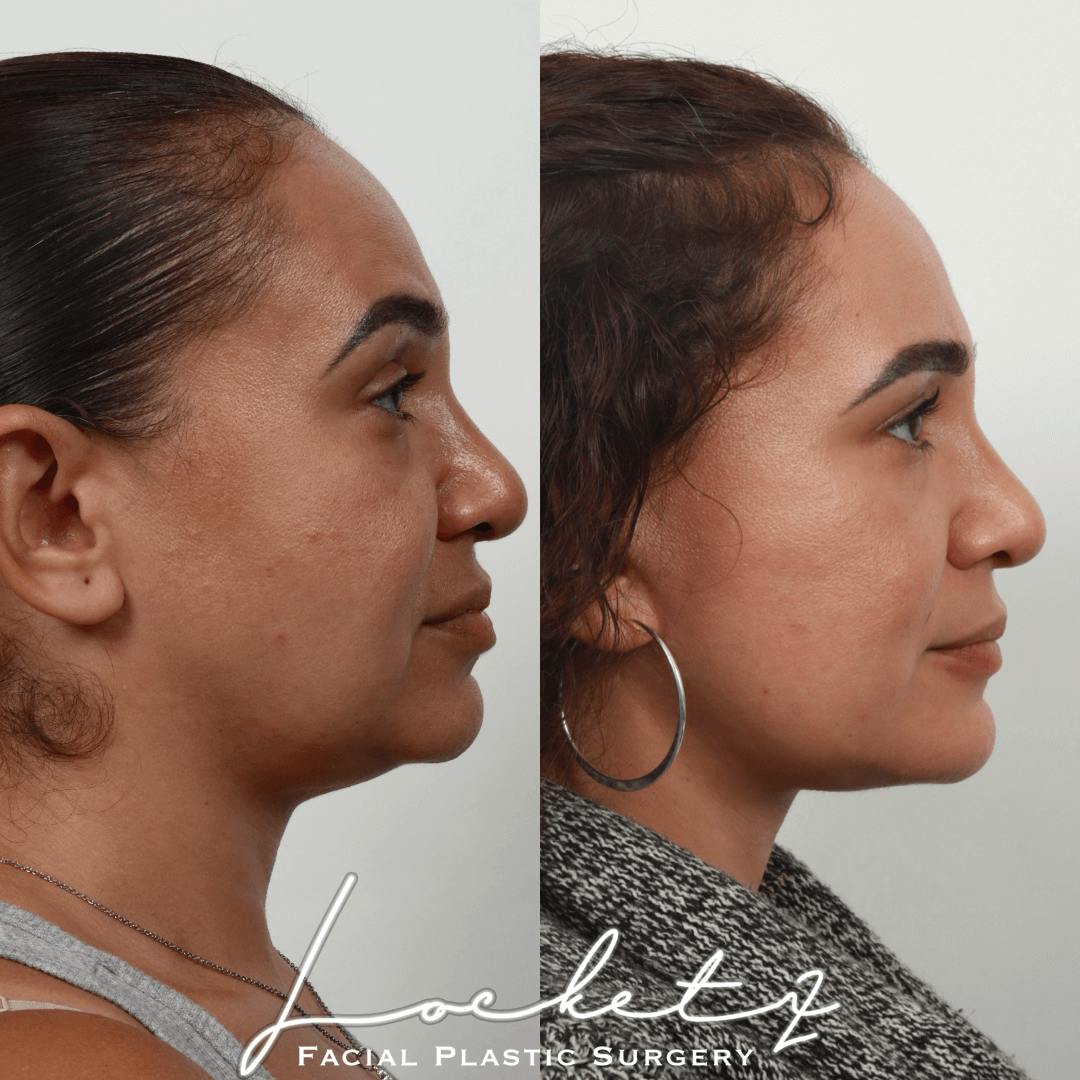 Deep Plane Facelift Before & After Gallery - Patient 55610379 - Image 3
