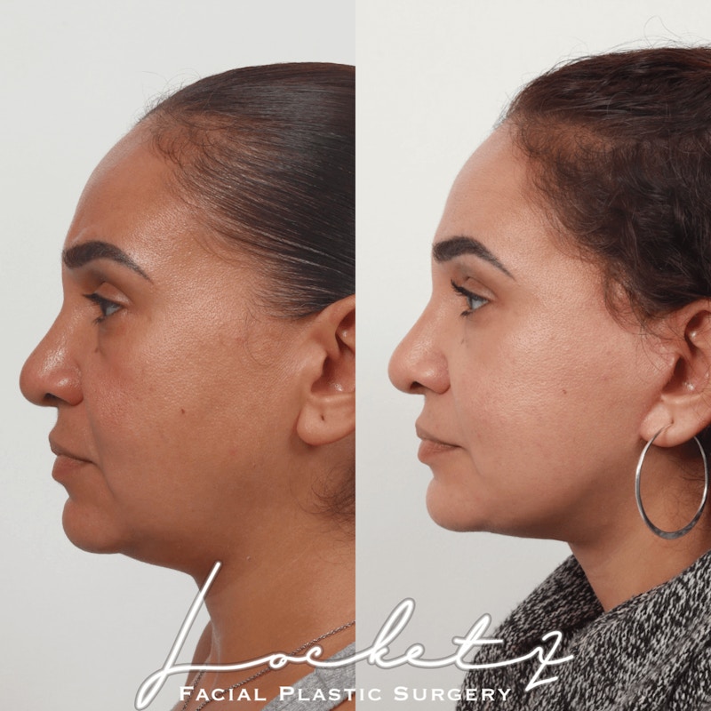 Deep Neck Lift Before & After Gallery - Patient 60745313 - Image 1