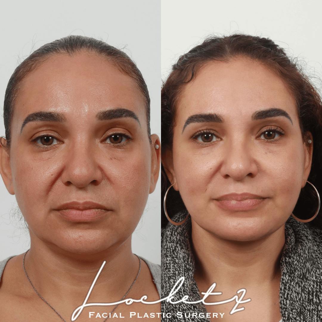 Deep Neck Lift Before & After Gallery - Patient 60745313 - Image 5