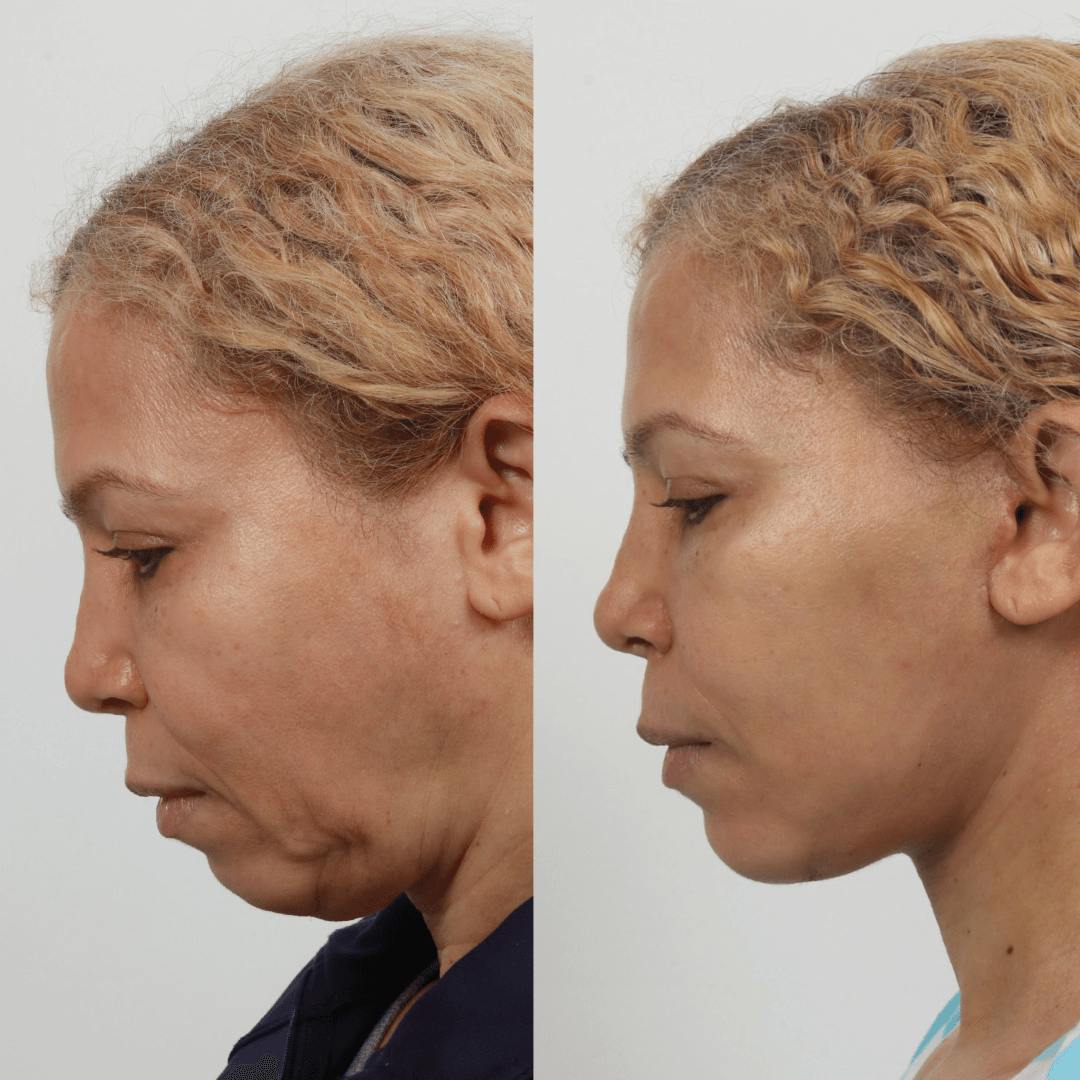 Deep Plane Facelift Before & After Gallery - Patient 55611644 - Image 2