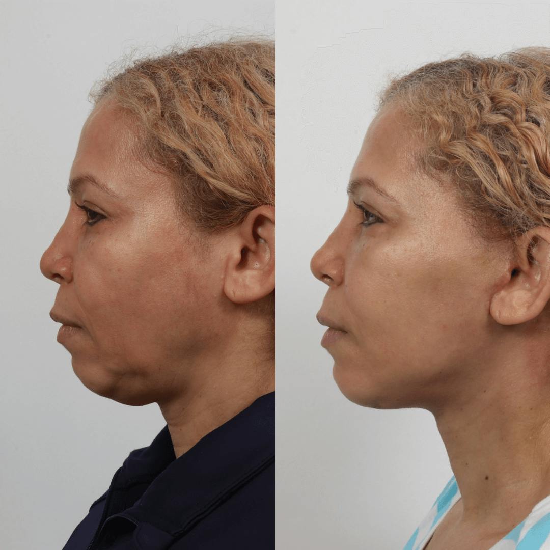 Deep Plane Facelift Before & After Gallery - Patient 55611644 - Image 4