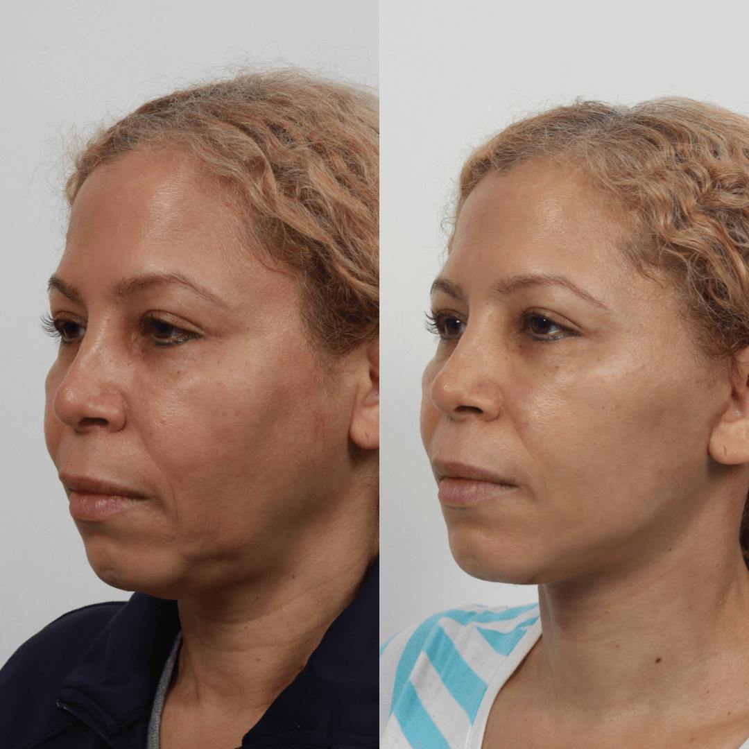 Deep Plane Facelift Before & After Gallery - Patient 55611644 - Image 1