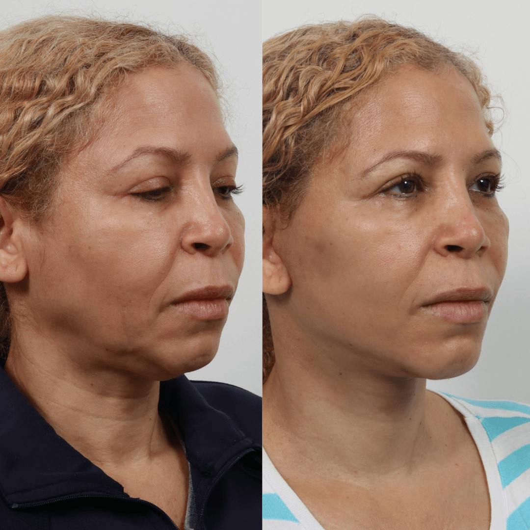 Deep Plane Facelift Before & After Gallery - Patient 55611644 - Image 5