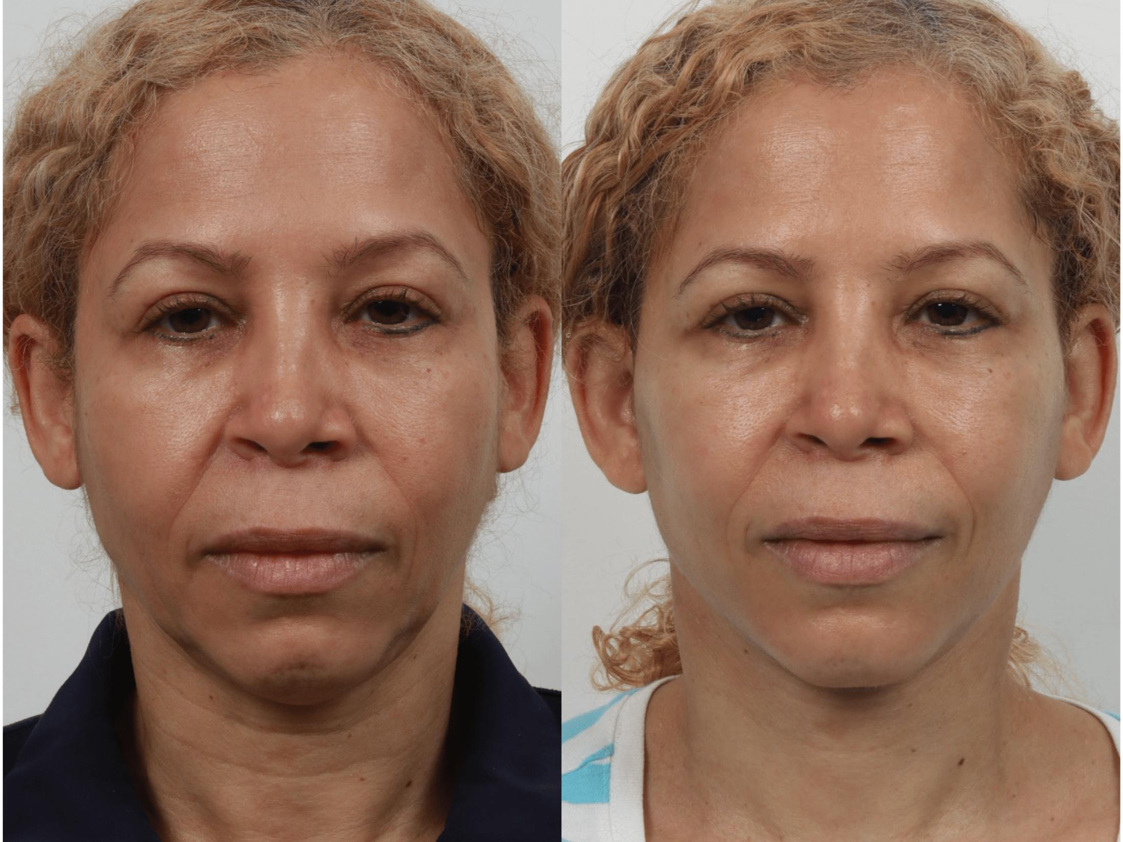 Deep Plane Facelift Before & After Gallery - Patient 55611644 - Image 2