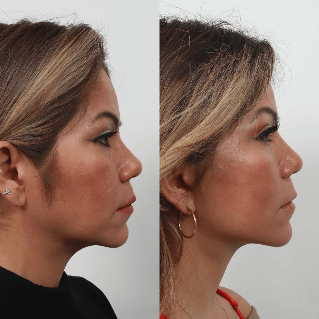 Deep Plane Facelift Before & After Gallery - Patient 55611647 - Image 2
