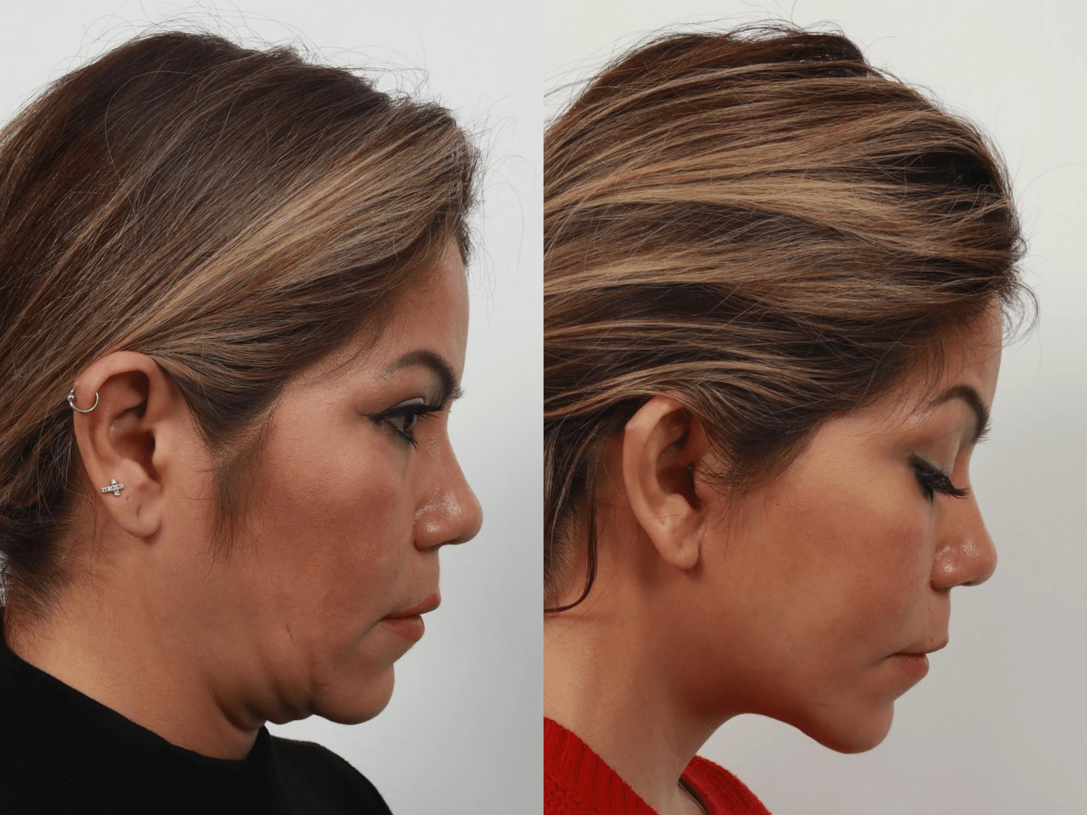 Deep Plane Facelift Before & After Gallery - Patient 55611647 - Image 5