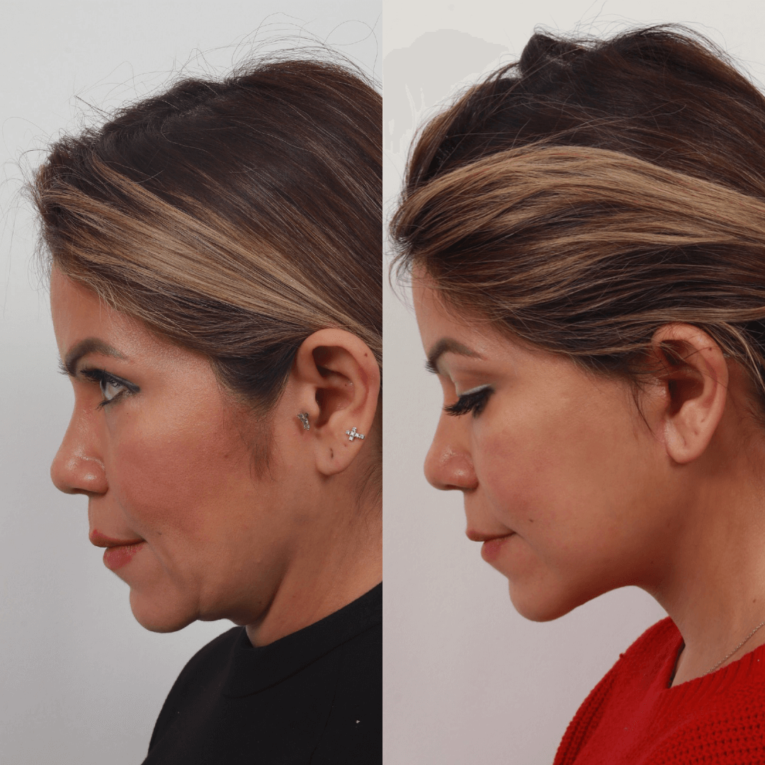 Facelift Denver Deep Plane Facelift in Denver, CO