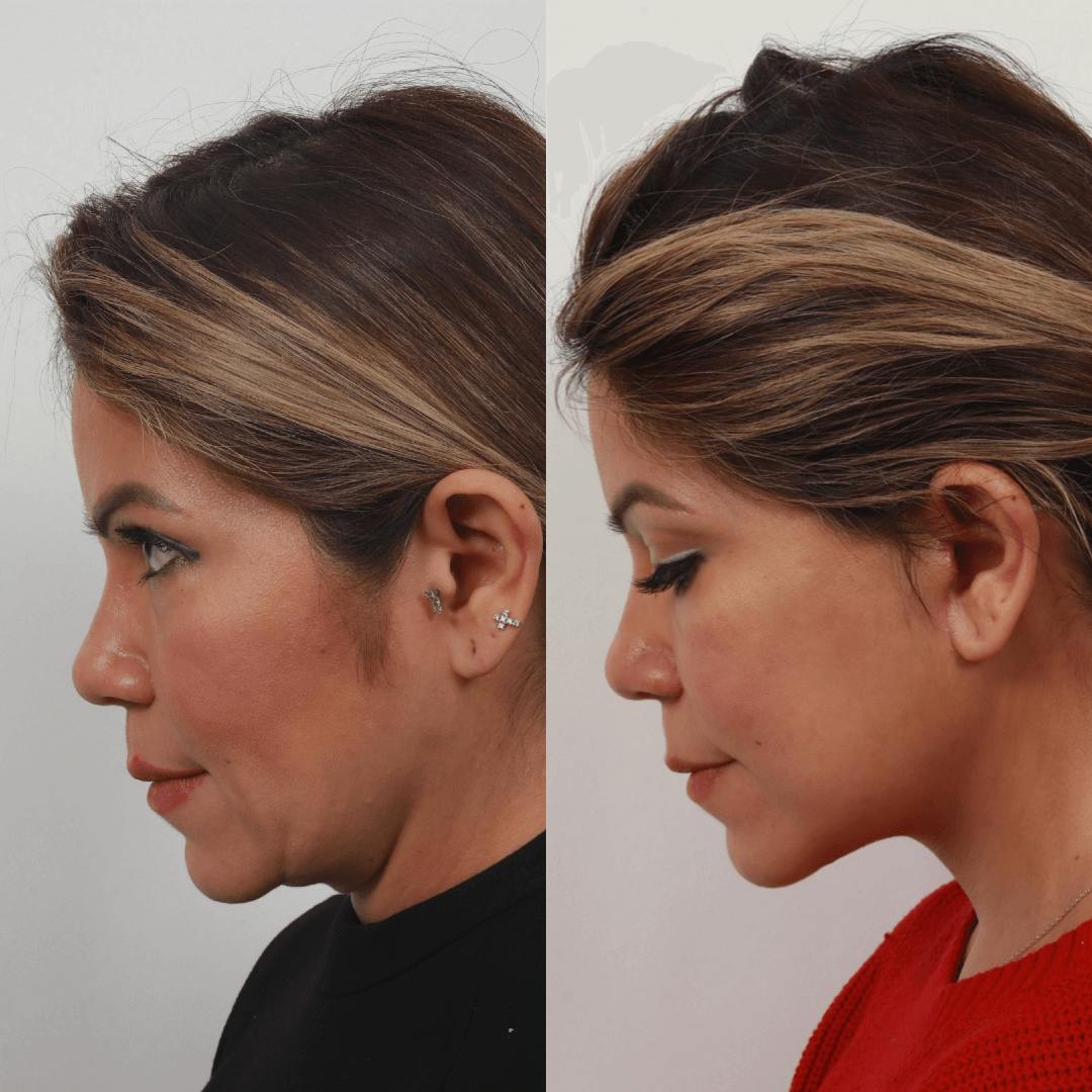 Deep Plane Facelift Before & After Gallery - Patient 55611647 - Image 1