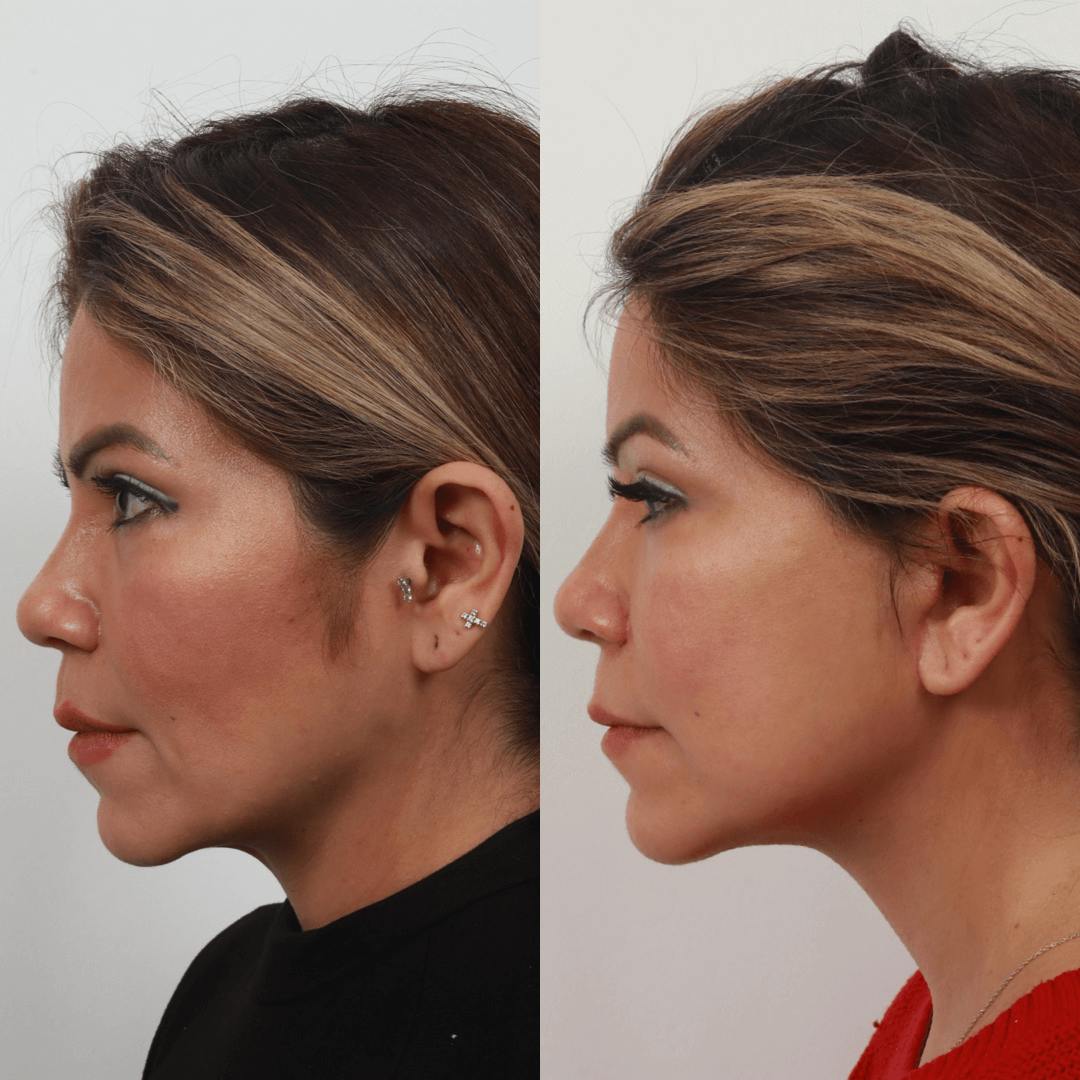 Deep Plane Facelift Before & After Gallery - Patient 55611647 - Image 5