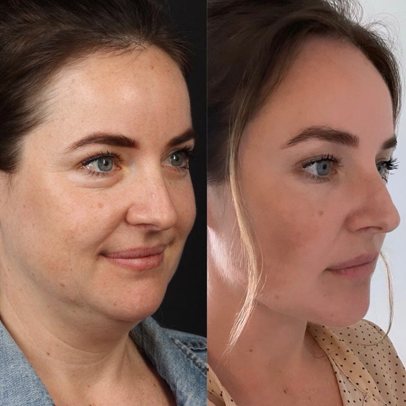 Deep Neck Lift Before & After Gallery - Patient 55611646 - Image 1