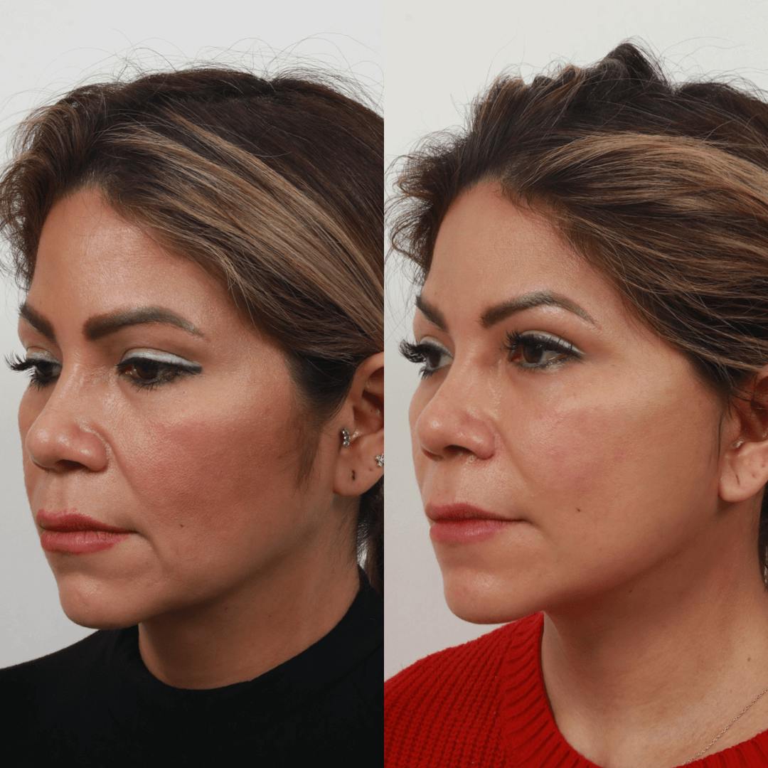Deep Plane Facelift Before & After Gallery - Patient 55611647 - Image 1