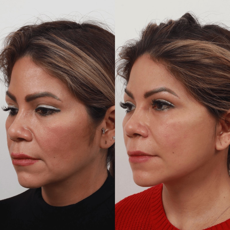 Deep Plane Facelift Before & After Gallery - Patient 55611647 - Image 1