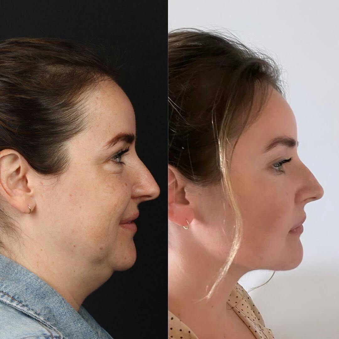 Deep Neck Lift Before & After Gallery - Patient 55611646 - Image 2