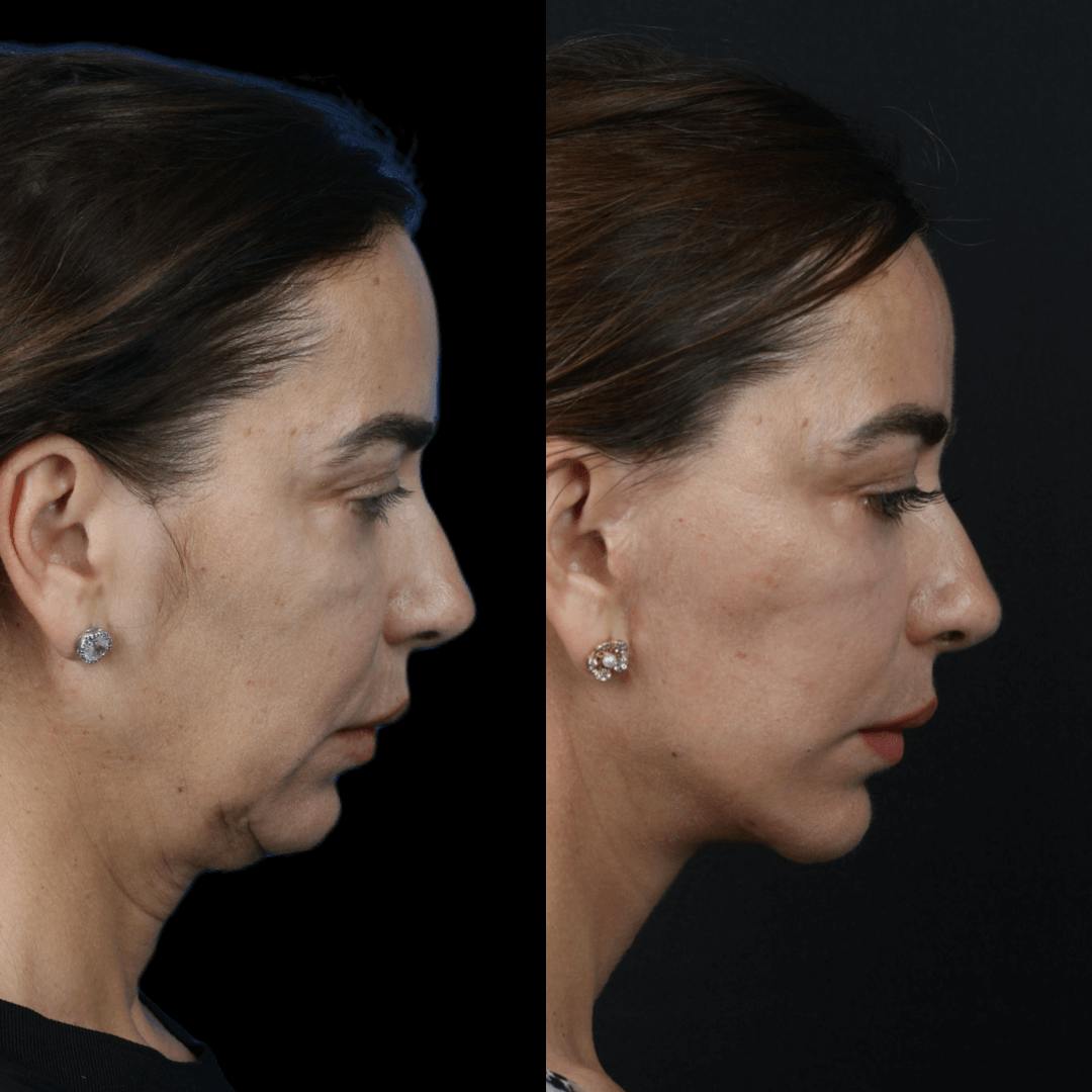 Deep Plane Facelift Before & After Gallery - Patient 55611648 - Image 3