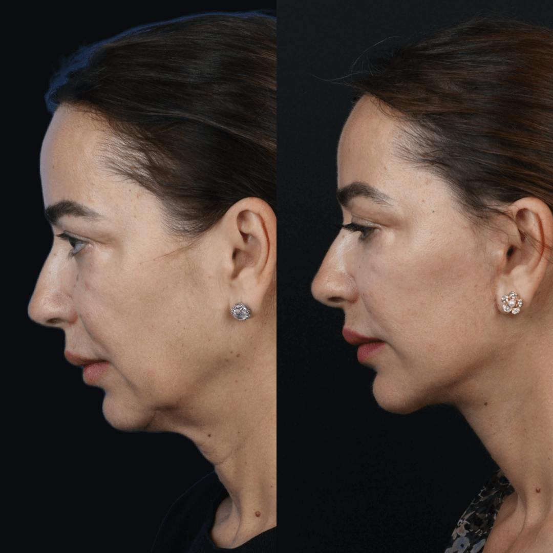 Deep Plane Facelift Before & After Gallery - Patient 55611648 - Image 2