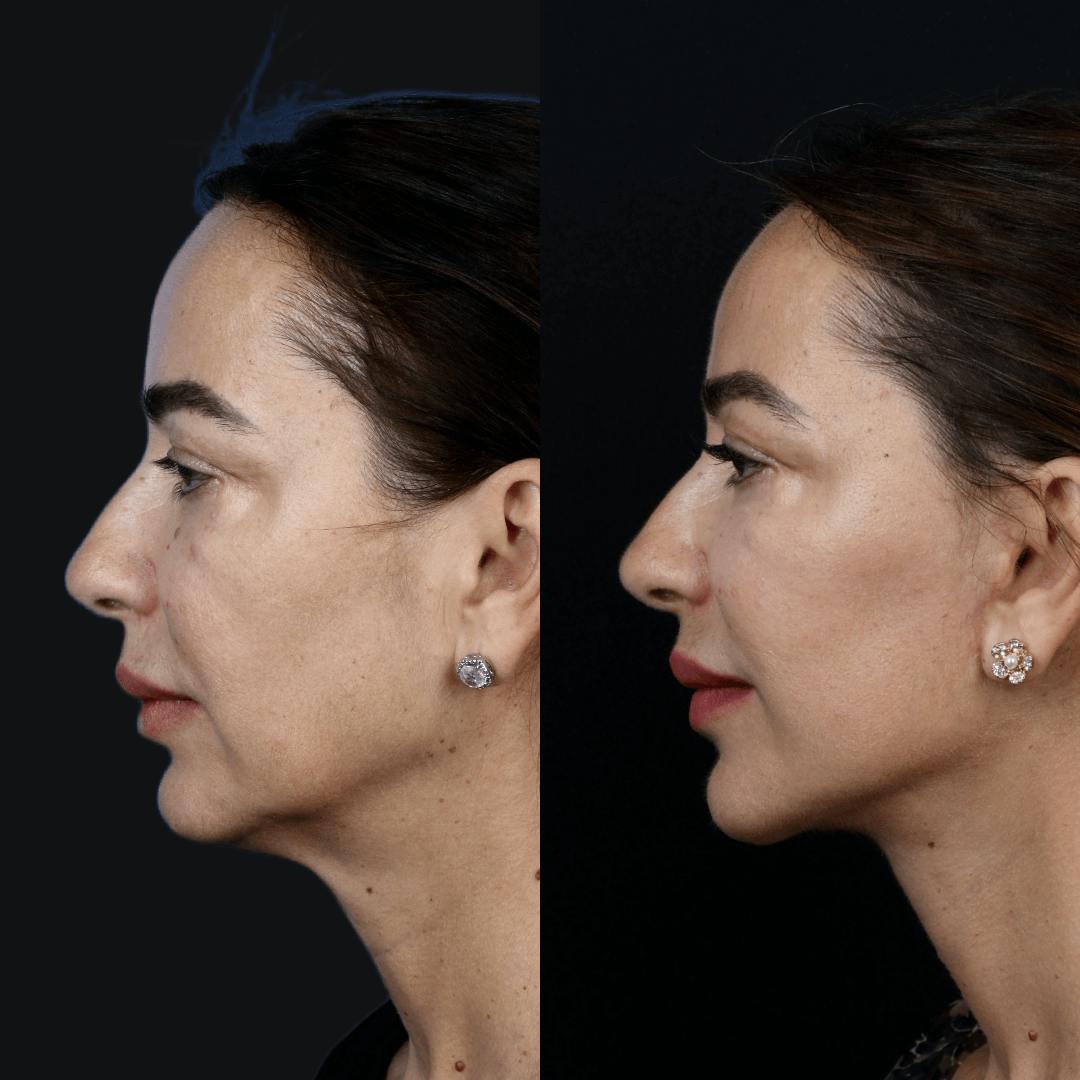 Deep Plane Facelift Before & After Gallery - Patient 55611648 - Image 5