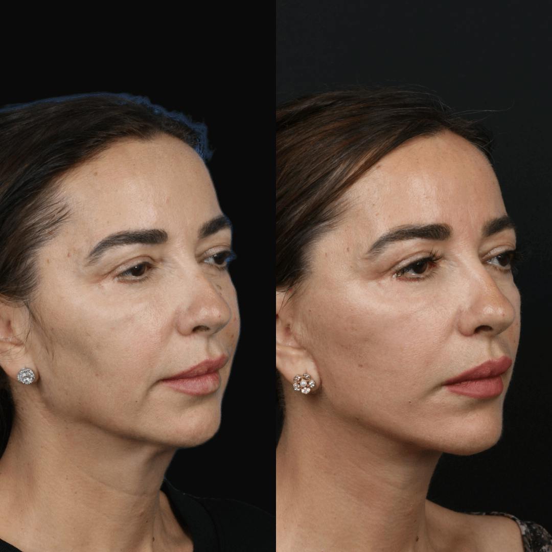 Deep Plane Facelift Before & After Gallery - Patient 55611648 - Image 4