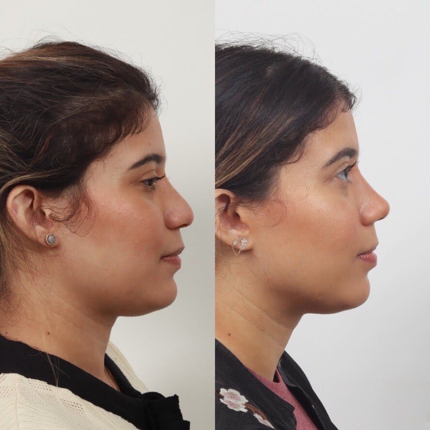 Rhinoplasty Before & After Gallery - Patient 55611657 - Image 2