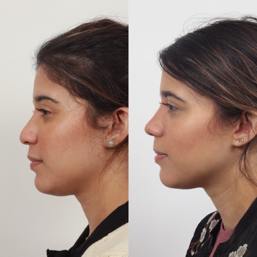 Rhinoplasty Before & After Gallery - Patient 55611657 - Image 1