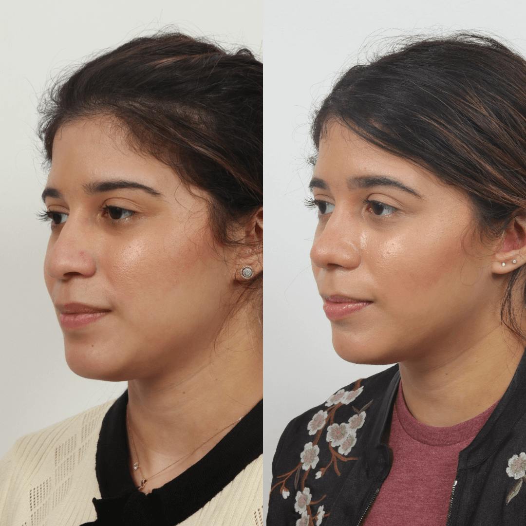 Rhinoplasty Before & After Gallery - Patient 55611657 - Image 3