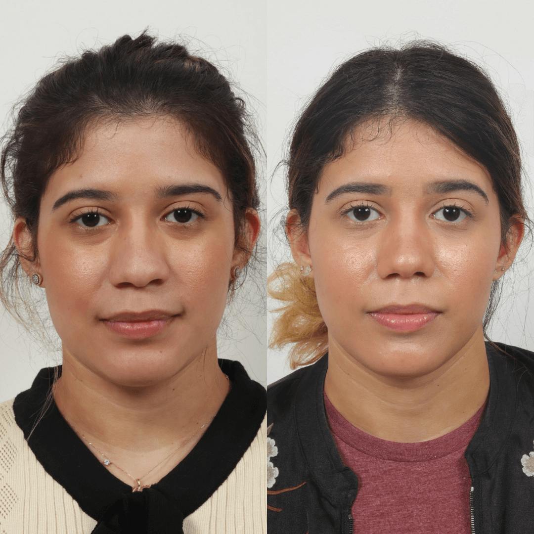 Rhinoplasty Before & After Gallery - Patient 55611657 - Image 4