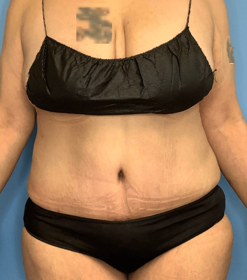 Vaser Liposuction Before & After Gallery - Patient 55612926 - Image 2
