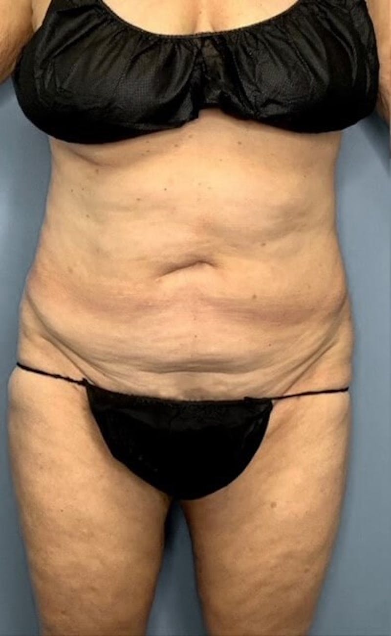 Tummy Tuck (Abdominoplasty)  Before & After Gallery - Patient 55612922 - Image 1