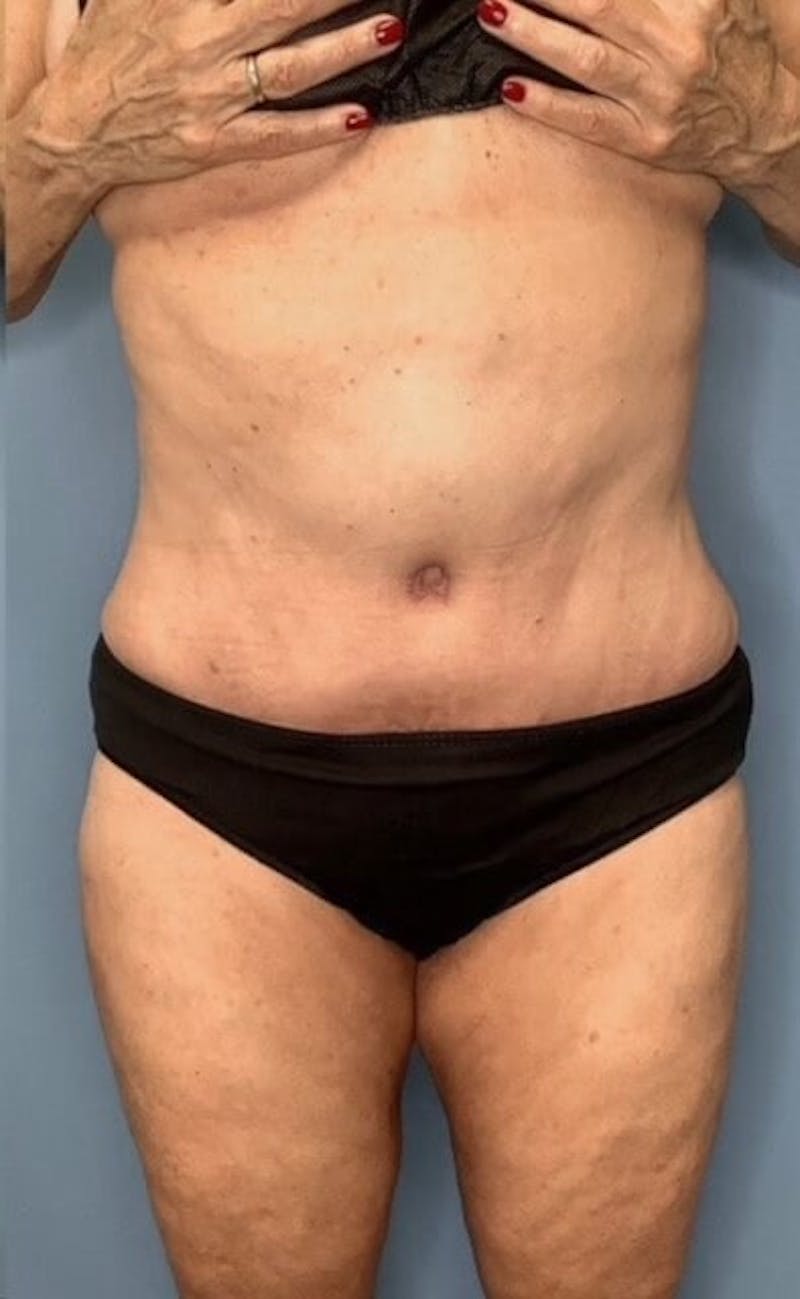 Tummy Tuck (Abdominoplasty)  Before & After Gallery - Patient 55612922 - Image 2