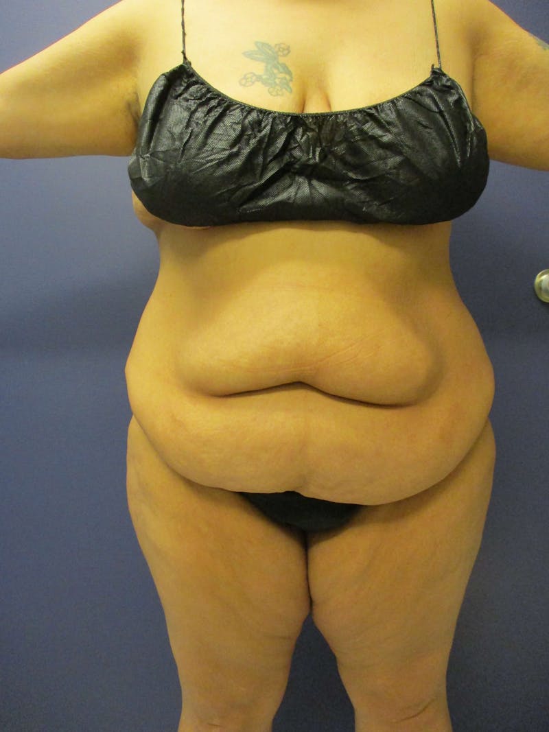 Vaser Liposuction Before & After Gallery - Patient 55612926 - Image 5