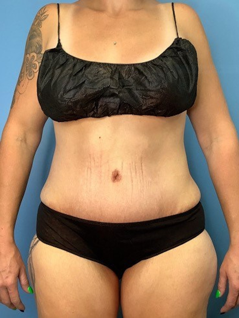 Tummy Tuck (Abdominoplasty)  Before & After Gallery - Patient 55612924 - Image 2
