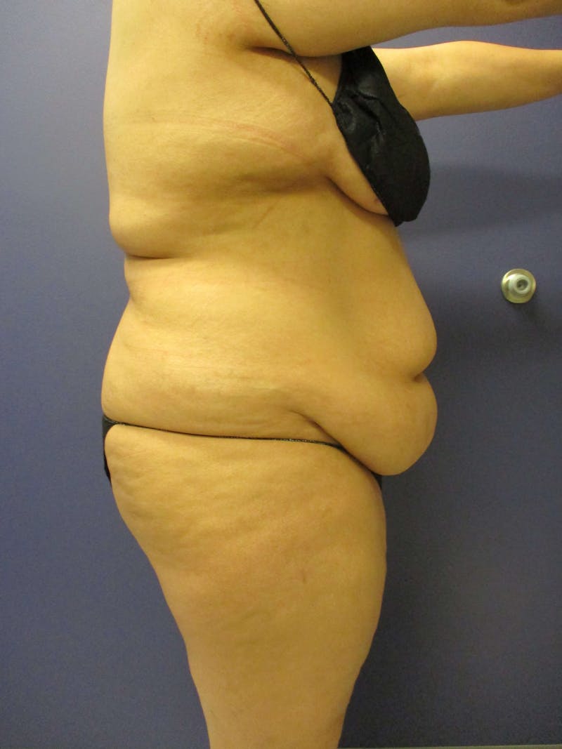 Vaser Liposuction Before & After Gallery - Patient 55612926 - Image 7