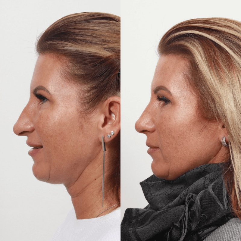 Rhinoplasty Before & After Gallery - Patient 55612929 - Image 1