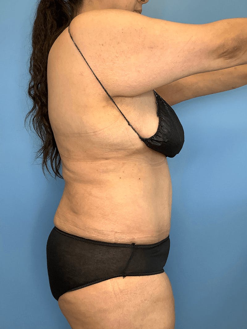 Vaser Liposuction Before & After Gallery - Patient 55612926 - Image 8