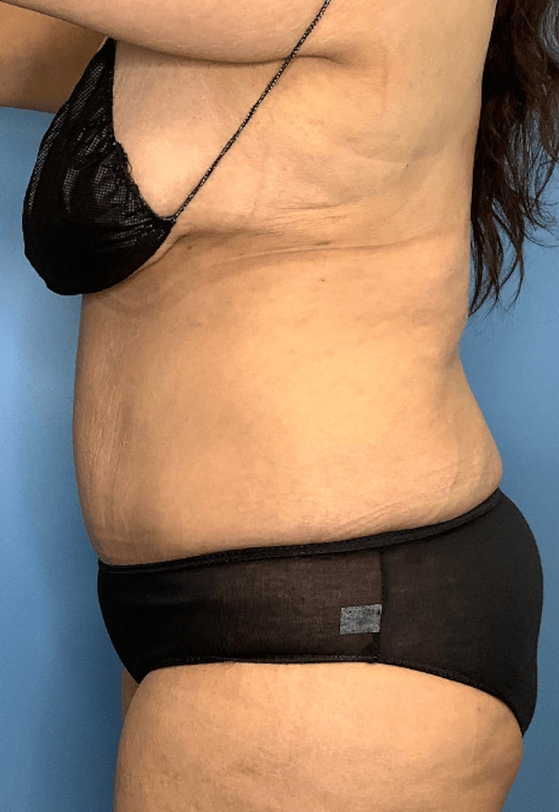 Tummy Tuck (Abdominoplasty)  Before & After Gallery - Patient 55612932 - Image 4