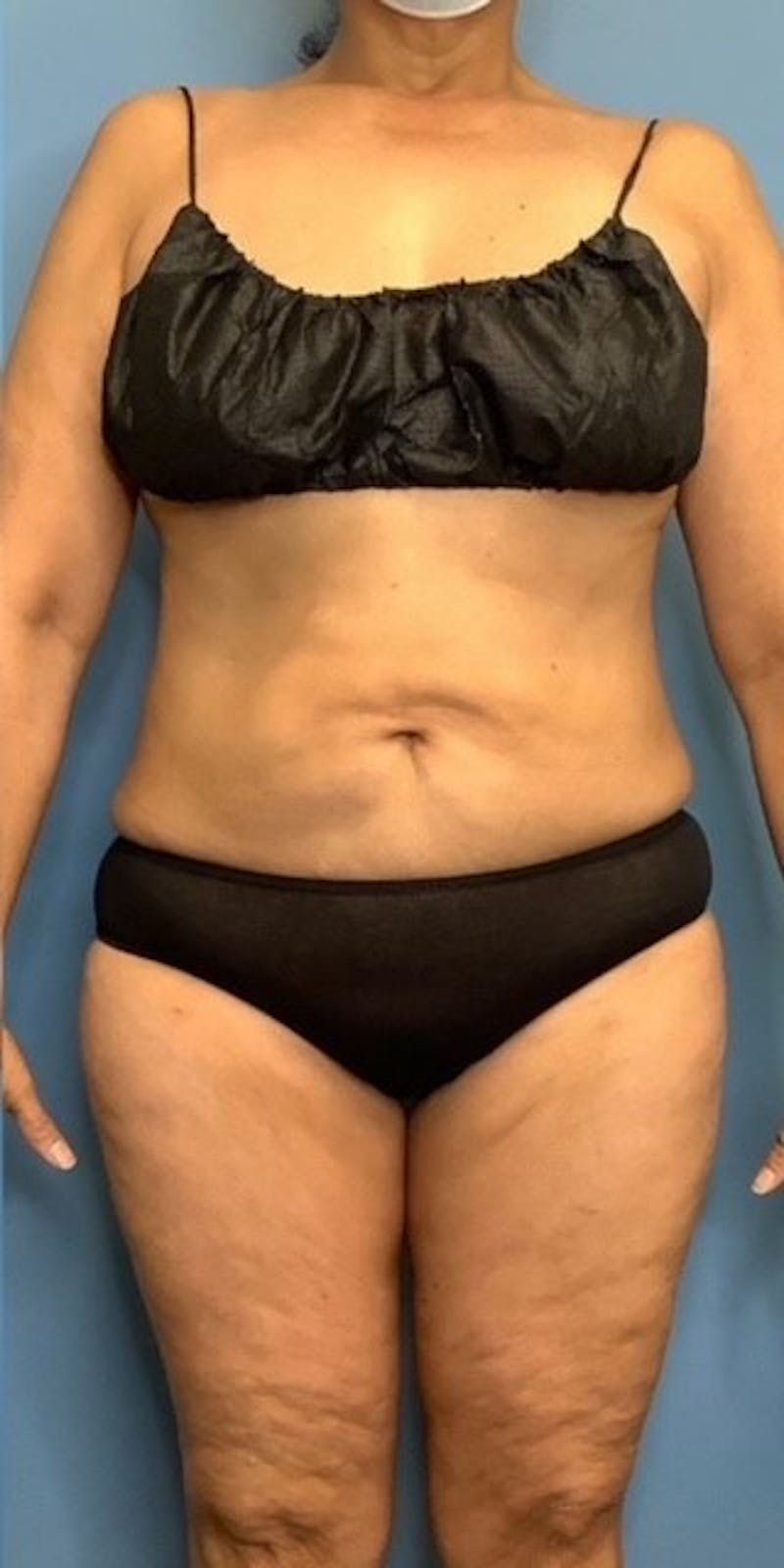 Vaser Liposuction Before & After Gallery - Patient 55612928 - Image 2