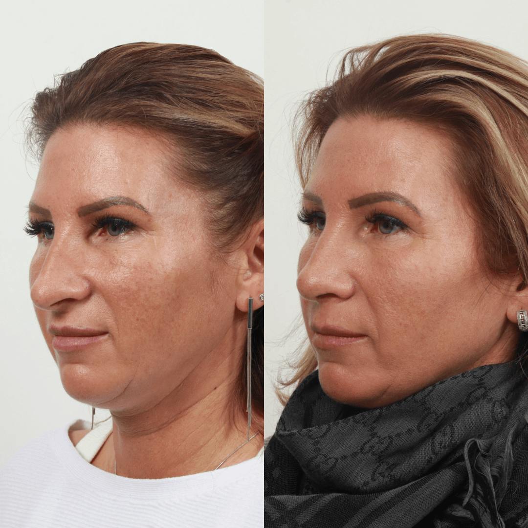 Rhinoplasty Before & After Gallery - Patient 55612929 - Image 4