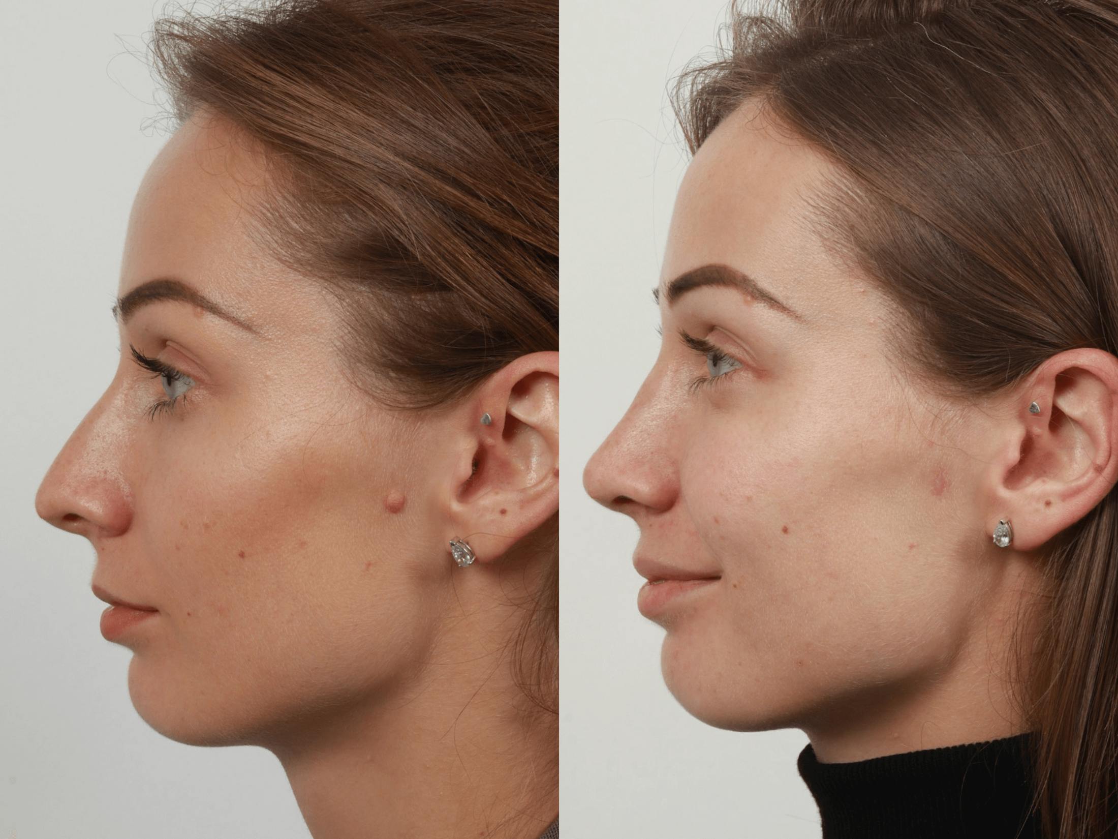 Rhinoplasty Before & After Gallery - Patient 55612936 - Image 1