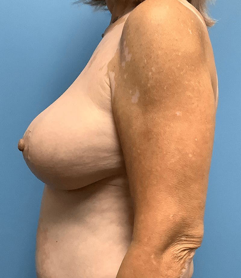 Breast Lift Before & After Gallery - Patient 55612931 - Image 2